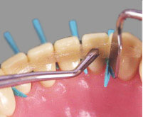 шинування зубів